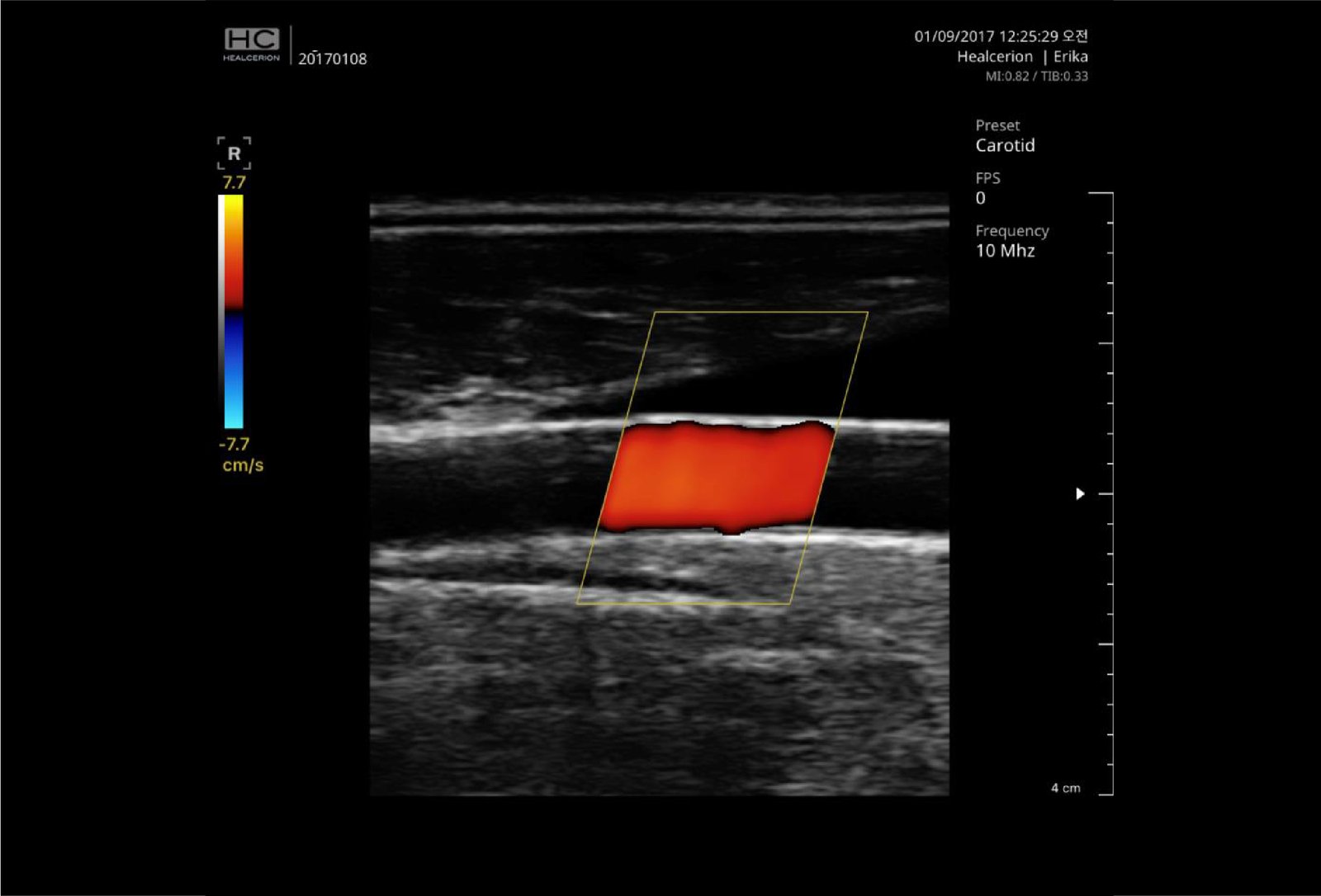 Carotid with CF