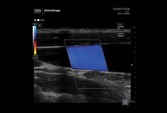 Jugular Vein with CF