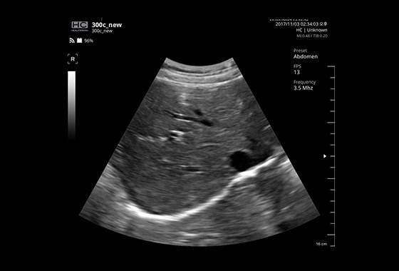 Liver IVC