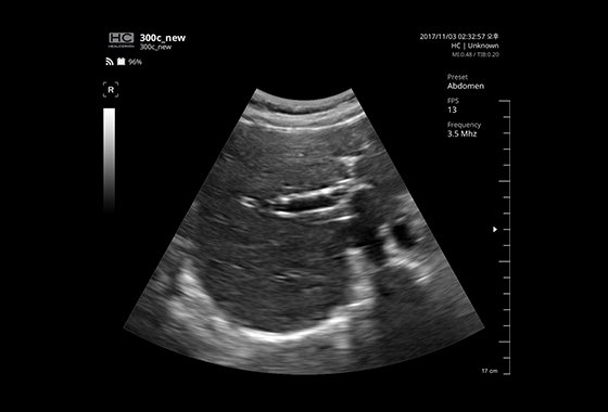 Liver Portal Vein