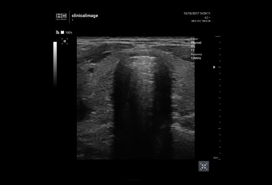 Thyroid Isthmus